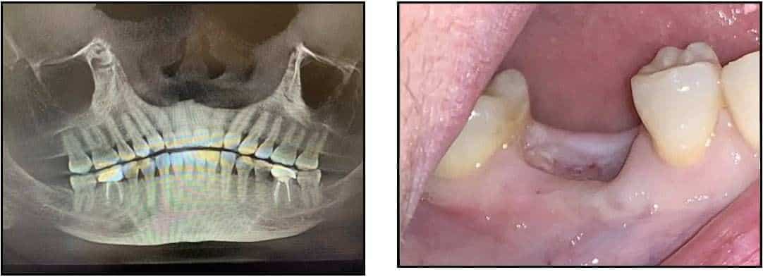 Delayed Placement of ZERAMEX XT Implants 1