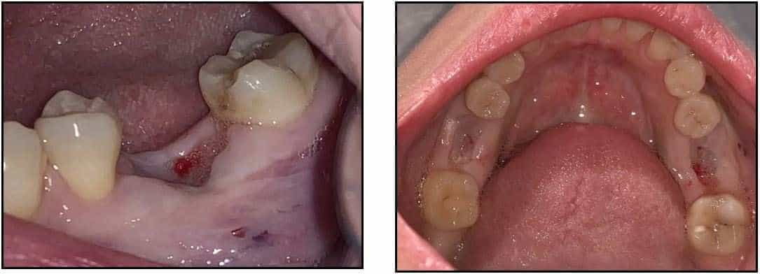 Delayed Placement of ZERAMEX XT Implants 2