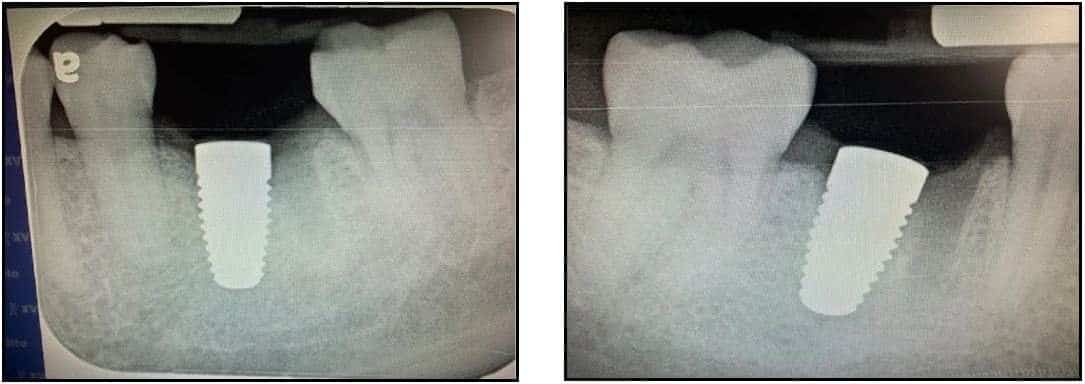 Delayed Placement of ZERAMEX XT Implants 3
