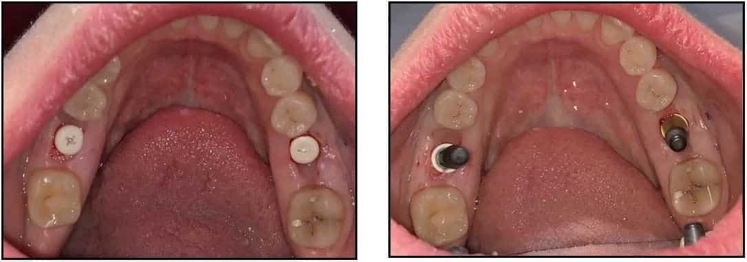 Delayed Placement of ZERAMEX XT Implants 4