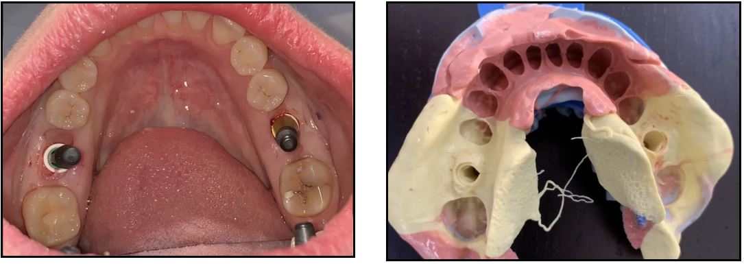 Delayed Placement of ZERAMEX XT Implants 5