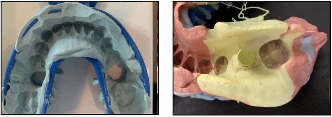 Delayed Placement of ZERAMEX XT Implants 7