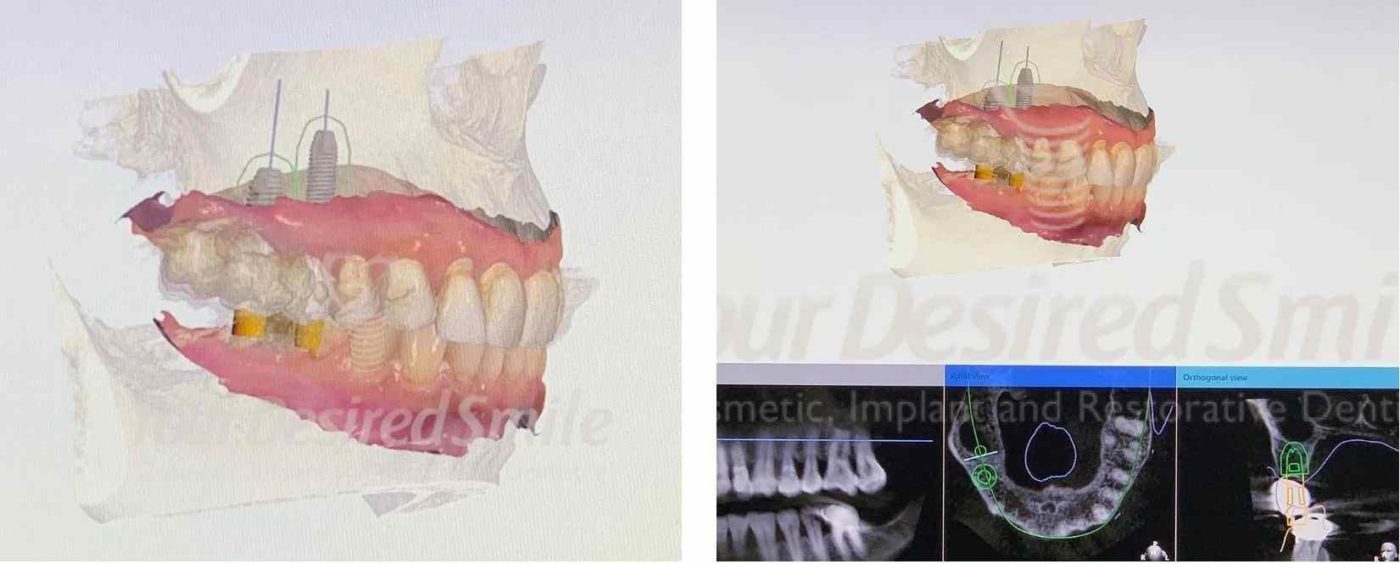 Posterior Zirconia Implants Guided Surgery Fig 1