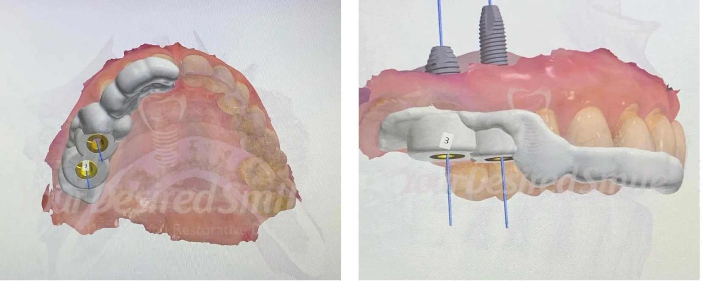 Posterior Zirconia Implants Guided Surgery Fig 2