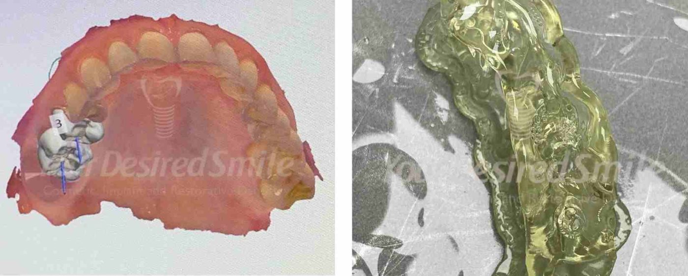 Posterior Zirconia Implants Guided Surgery Fig 3