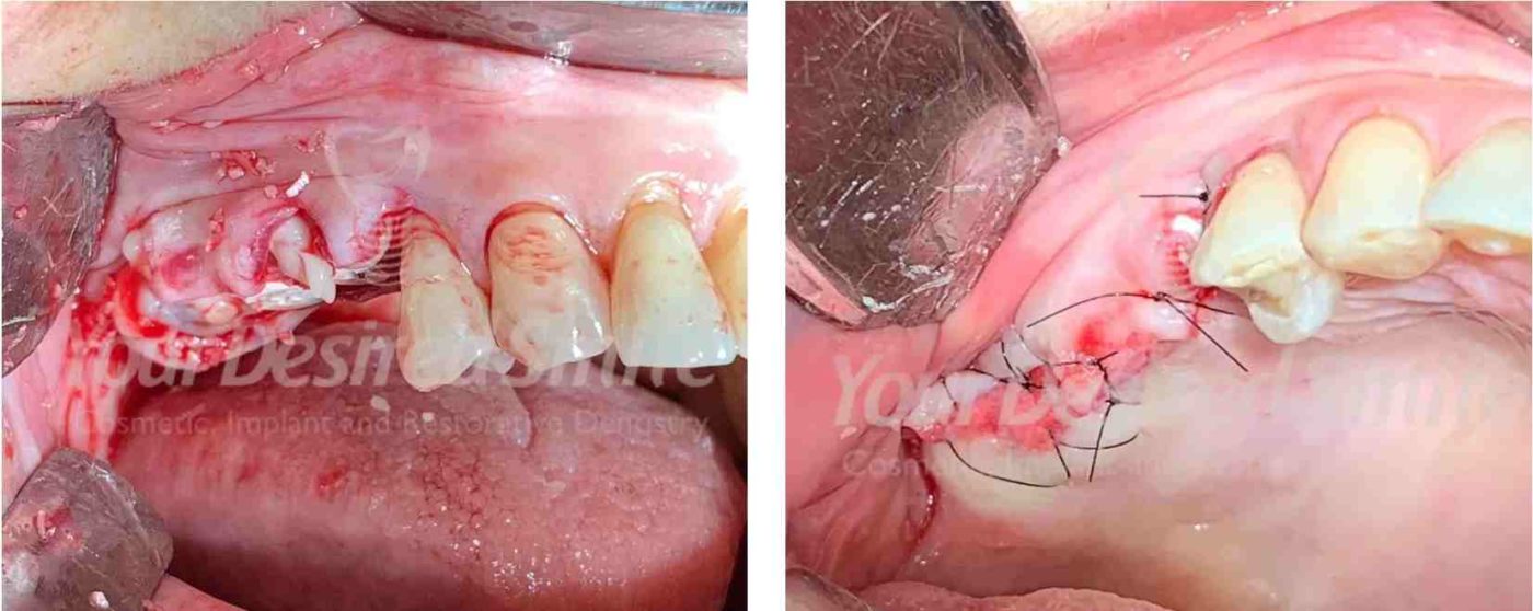 Posterior Zirconia Implants Guided Surgery Fig 5