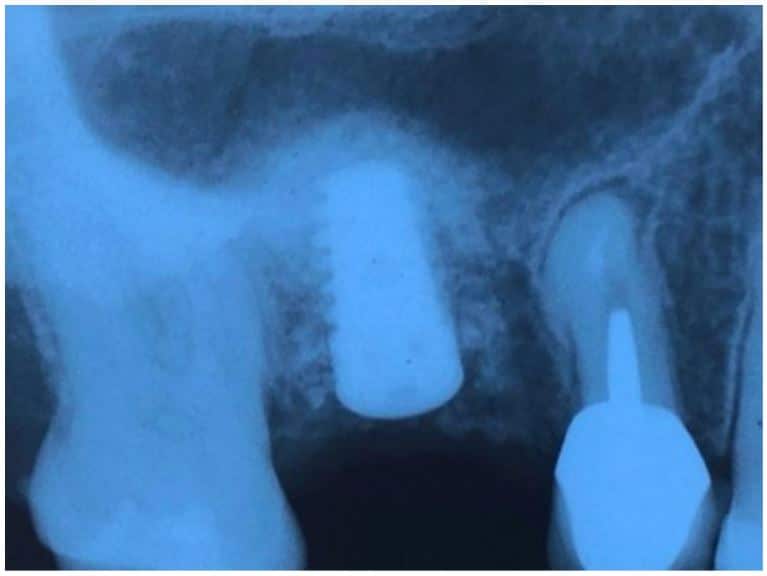 Augma 17