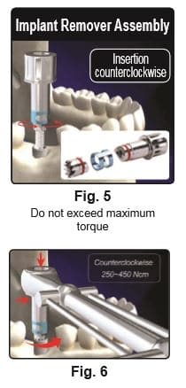 Implant Remover Kit Gen2