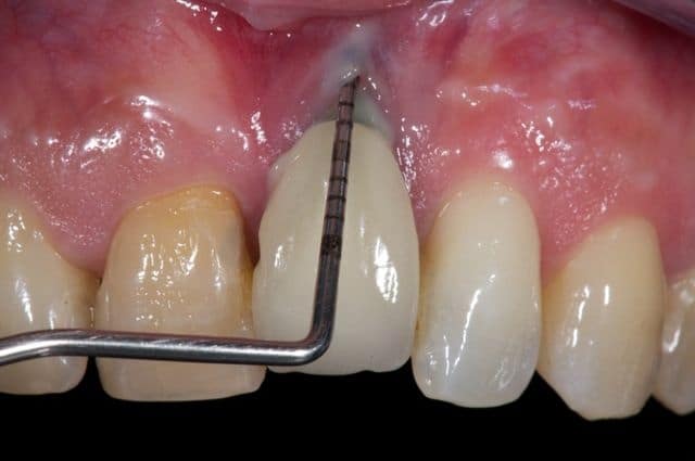 Titanium implant failure
